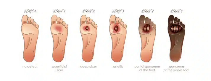 Stages of foot ulcer development