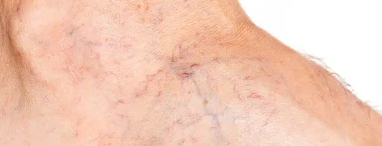 Varicose Veins