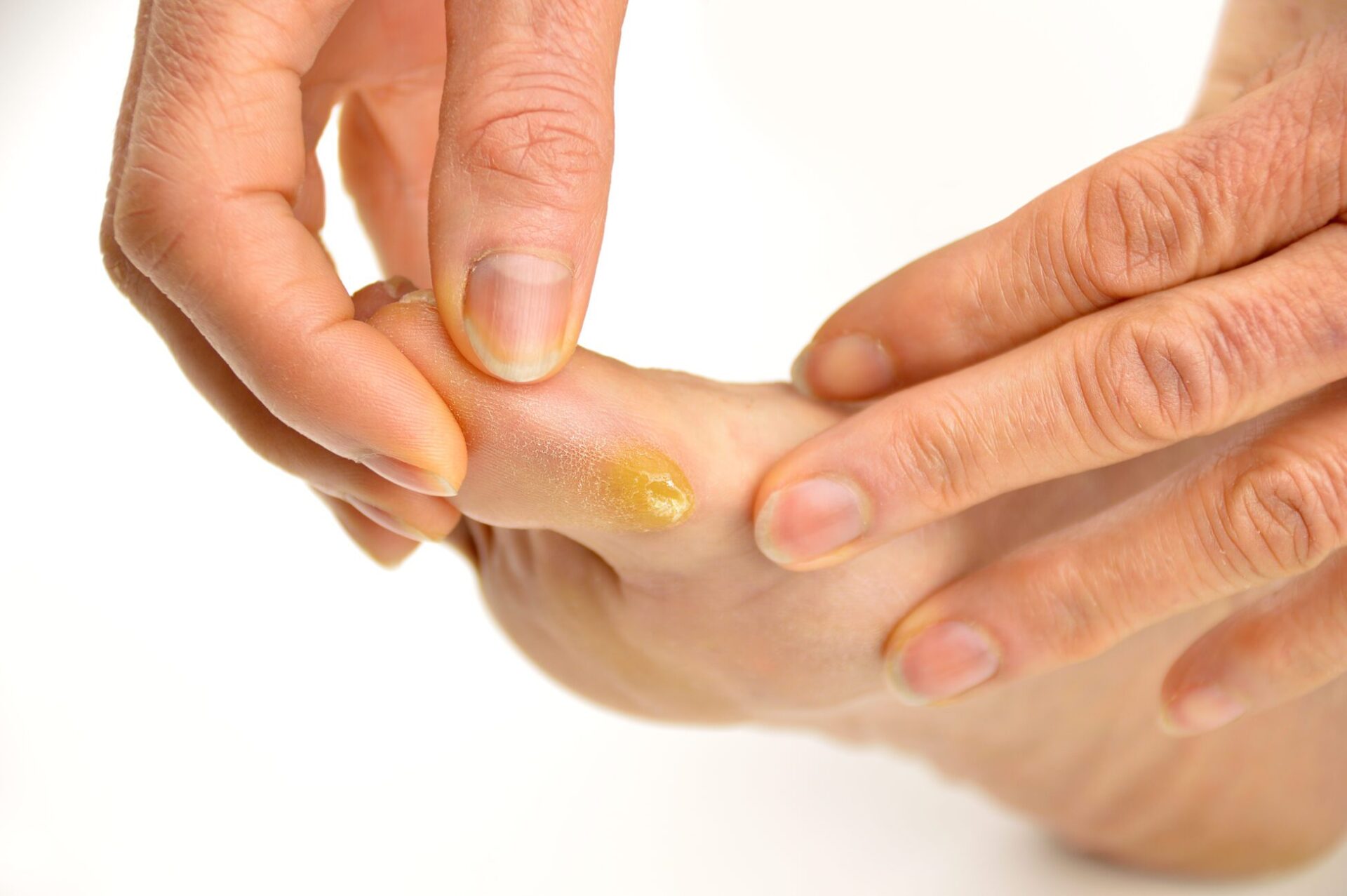Foot Corn Treatment & Callus Removal for the Elderly