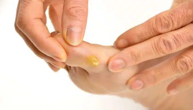 Close up of foot callus on side of the foot
