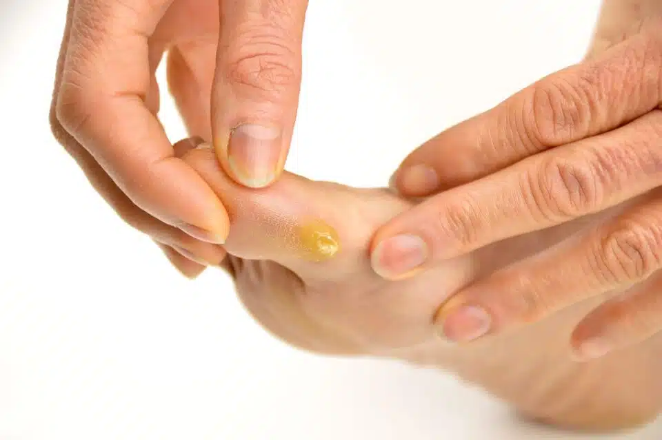 Close up of foot callus on side of the foot
