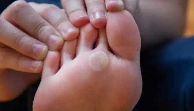 Person holds back toes to reveal corn on ball of the foot