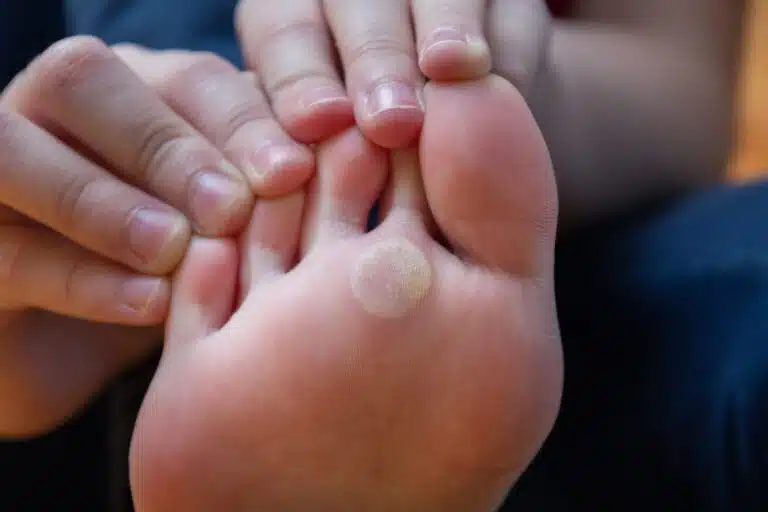 Person holds back toes to reveal corn on ball of the foot