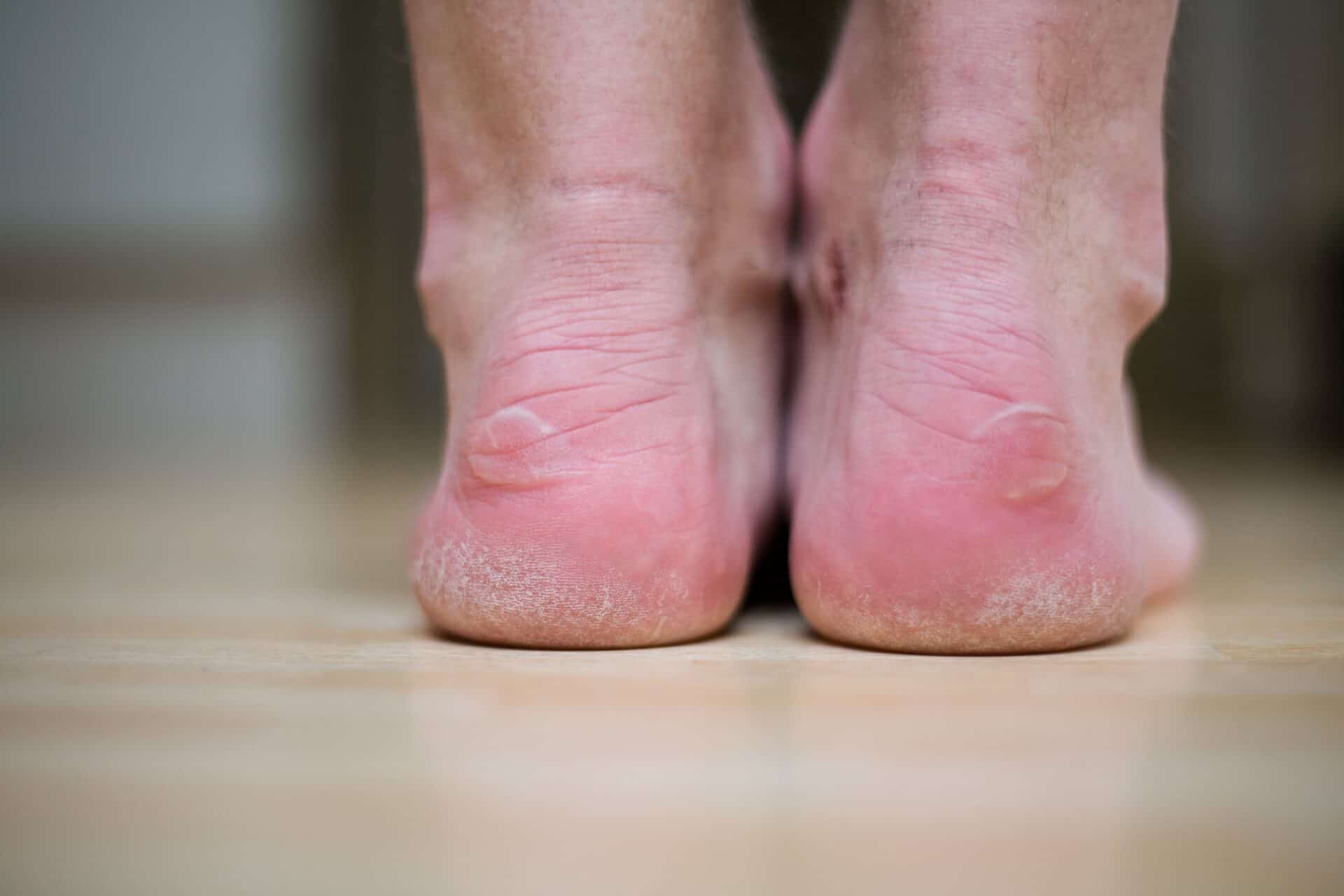 blister3