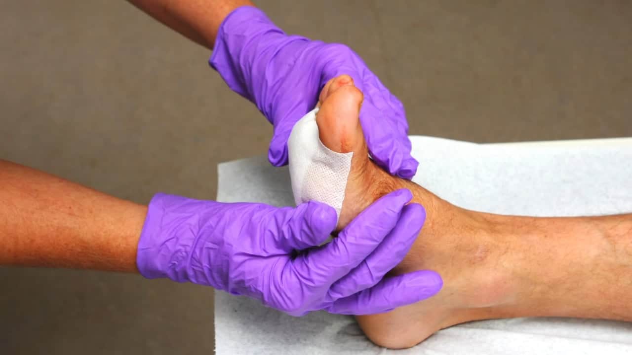 Foot Blisters Foot Specialist Toronto Feet First Clinic 8847
