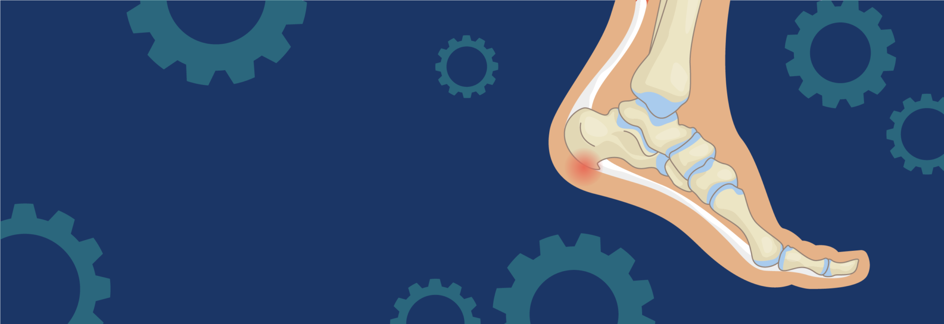 Illustration of a heel spur