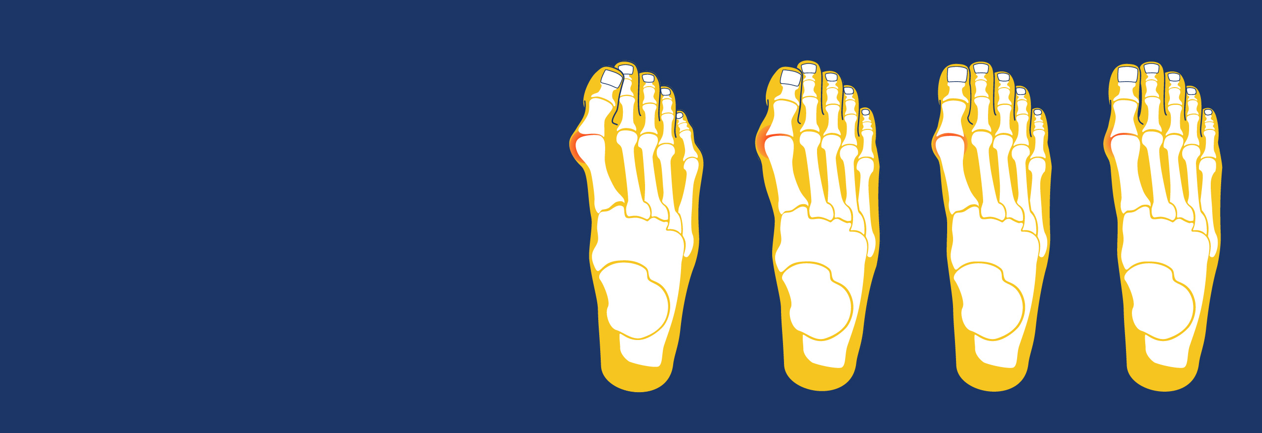 Different Stages of a Bunion | Feet First Clinic