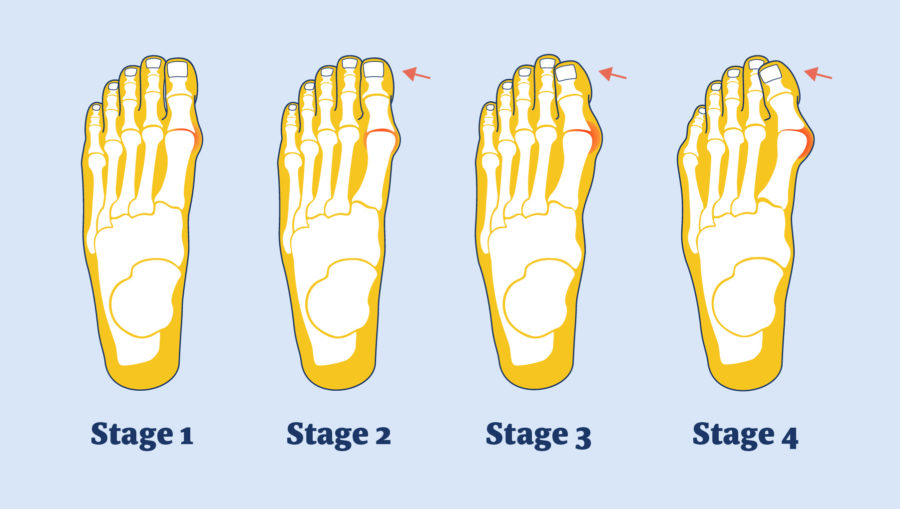 Different Stages of a Bunion | Feet First Clinic