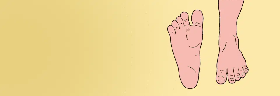Illustration of feet with corns on the ball of foot and around the toes
