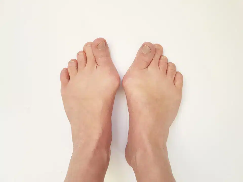 Two feet with bunions protruding from each side of the foot next to big toe and white background