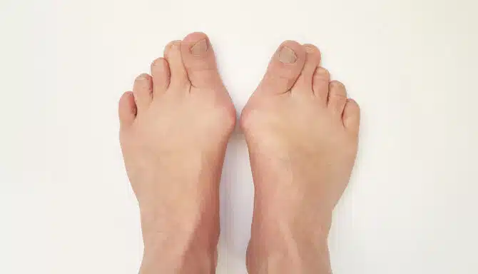 Two feet with protruding bunions coming out of the big toe area and a white background