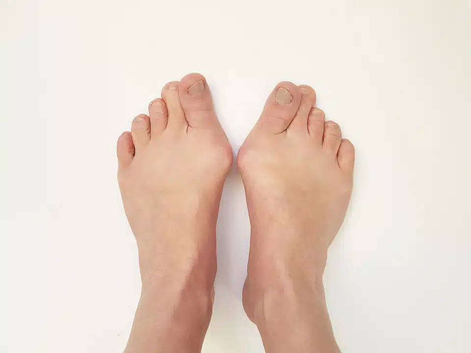 Two feet with protruding bunions coming out of the big toe area and a white background