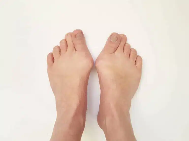 Bunions showing on the first MTJ on both feet