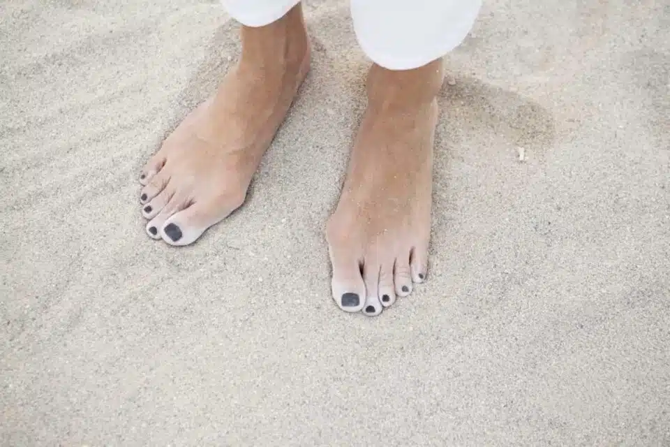 Close up of feet in sand showing bunions