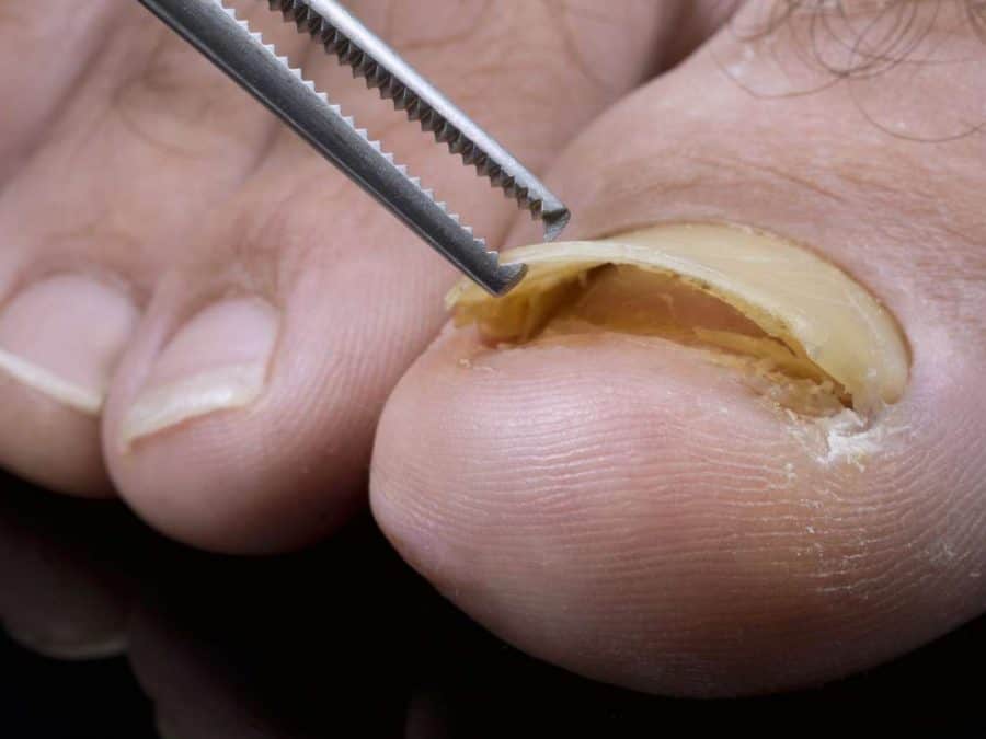 cracked-toenail-foot-specialist-toronto-feet-first-clinic