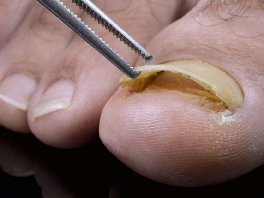 Cracked Toenail Foot Specialist Toronto Feet First Clinic