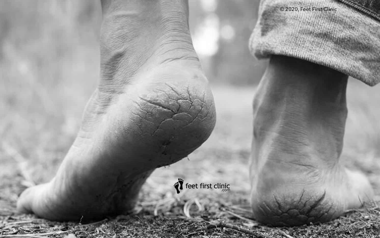 Ankle Popping And Cracking—Causes And Remedies Feet First Clinic