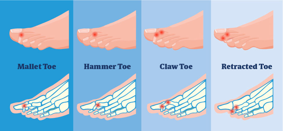 Toes curl do why What causes