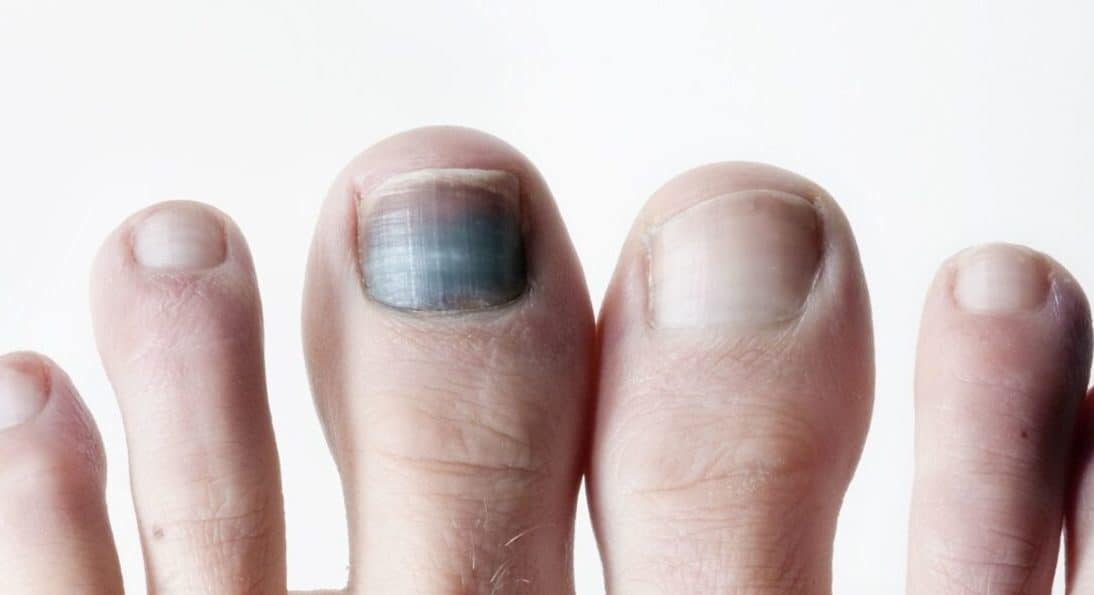 Discoloured Toenail | Feet First Clinic