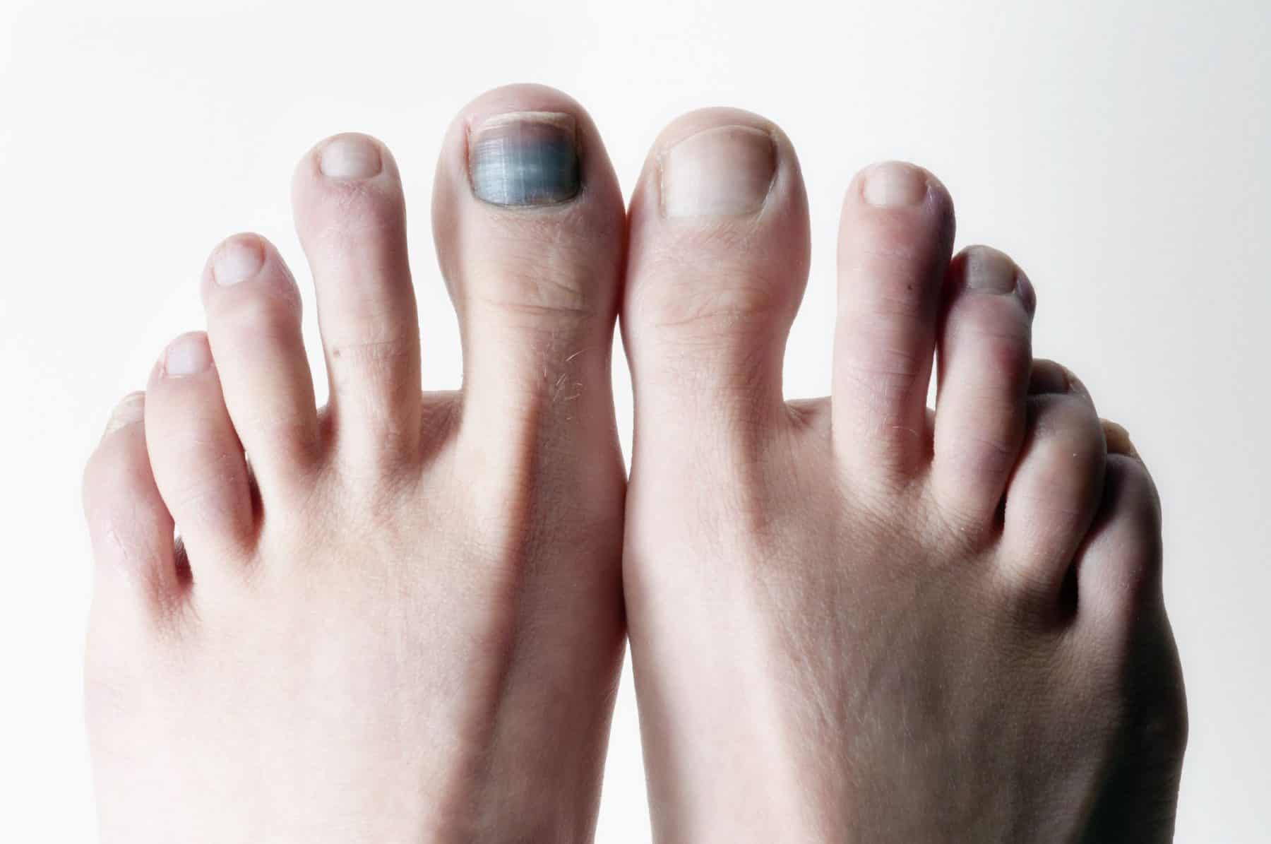 Discoloured Toenails Foot Specialist Toronto Feet First Clinic