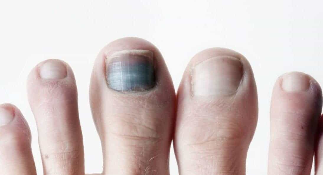 A Black Spot Under The Toenail: What Is It? - Feet First Clinic