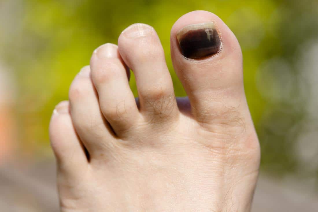 Clinical images showing characteristic discoloration of toe nails and... |  Download Scientific Diagram