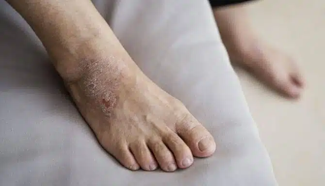 eczema toenail pitting