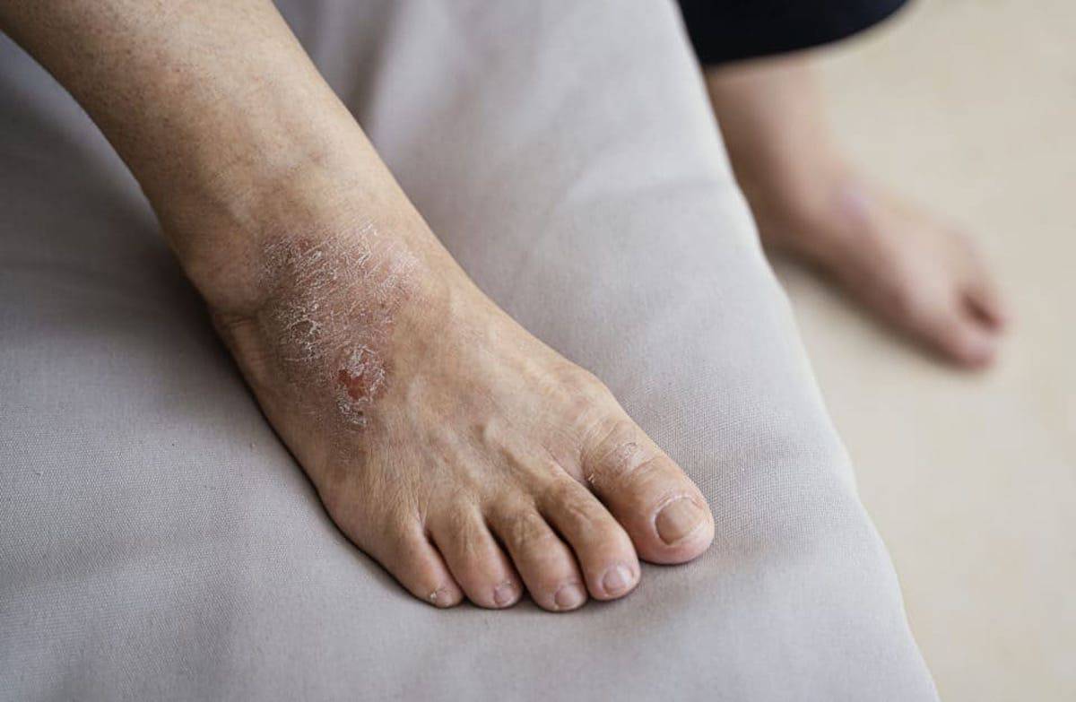 eczema toenail pitting