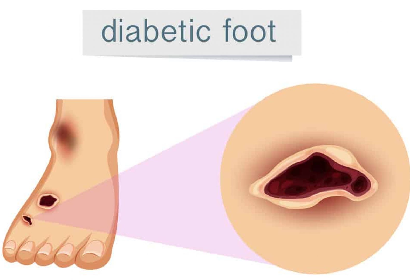 Illustration showing diabetic foot also known as a diabetic ulcer