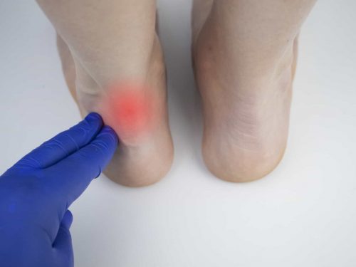 Achilles tendon and ankle diseases. Inflammation of the heel and foot, achillobursitis and achillotomy, rheumatism, tendon rupture. An orthopedic doctor examines a woman's leg.