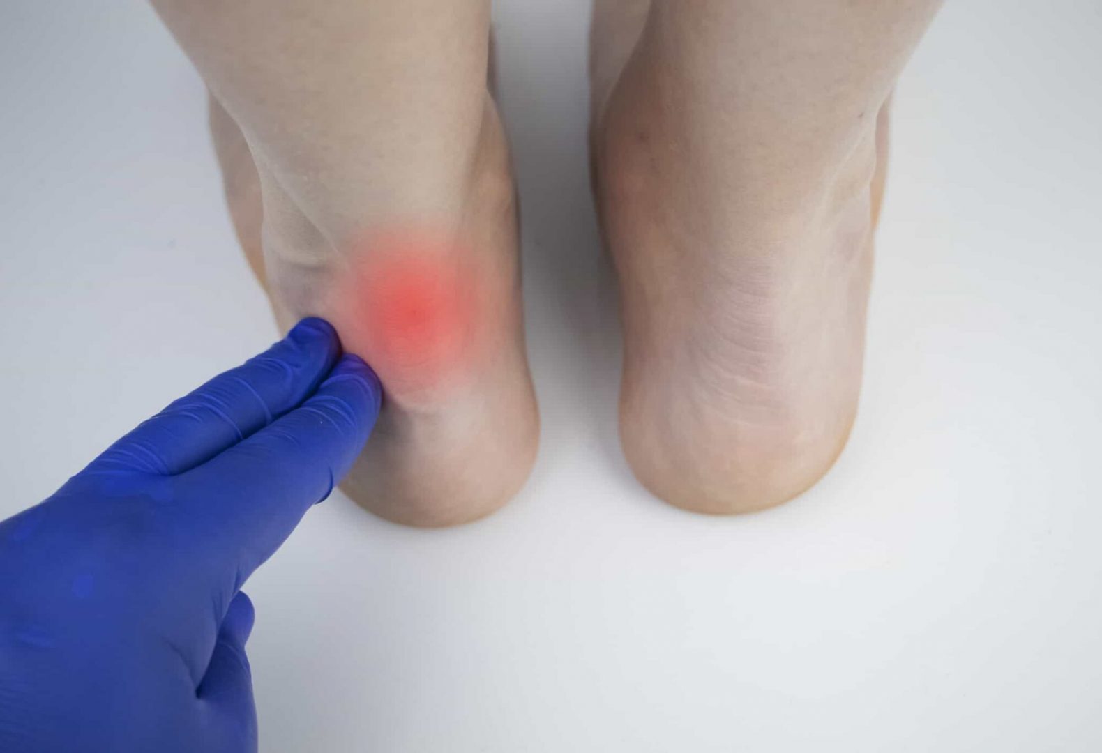 Achilles tendon and ankle diseases. Inflammation of the heel and foot, achillobursitis and achillotomy, rheumatism, tendon rupture. An orthopedic doctor examines a woman's leg.