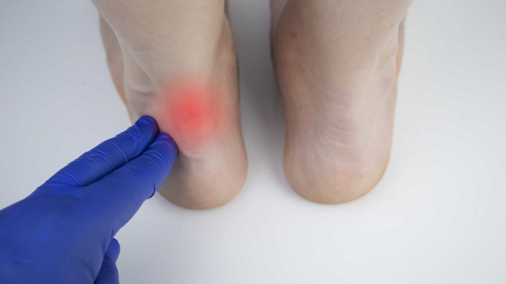 Achilles tendon and ankle diseases. Inflammation of the heel and foot, achillobursitis and achillotomy, rheumatism, tendon rupture. An orthopedic doctor examines a woman's leg.