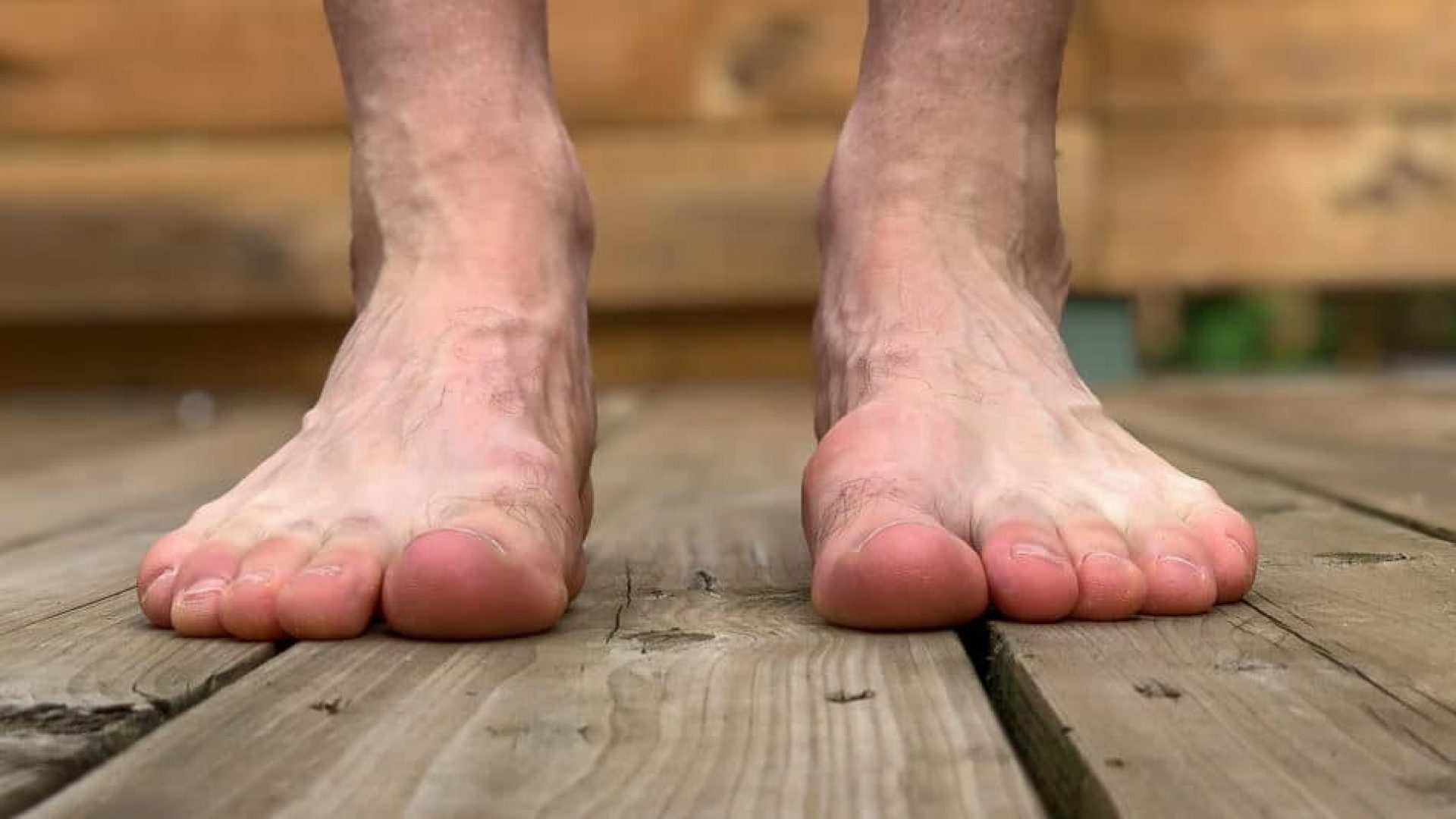Hallux Rigidus