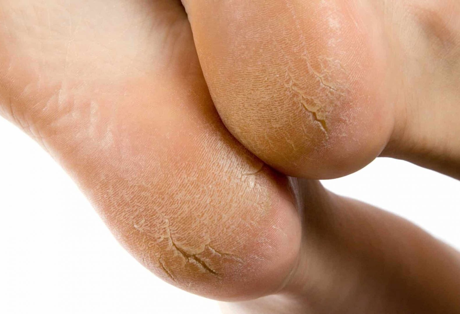 Dry and cracked soles of feet on white background. Shallow depth of field  **Forum Request**  You might also be interested in these: