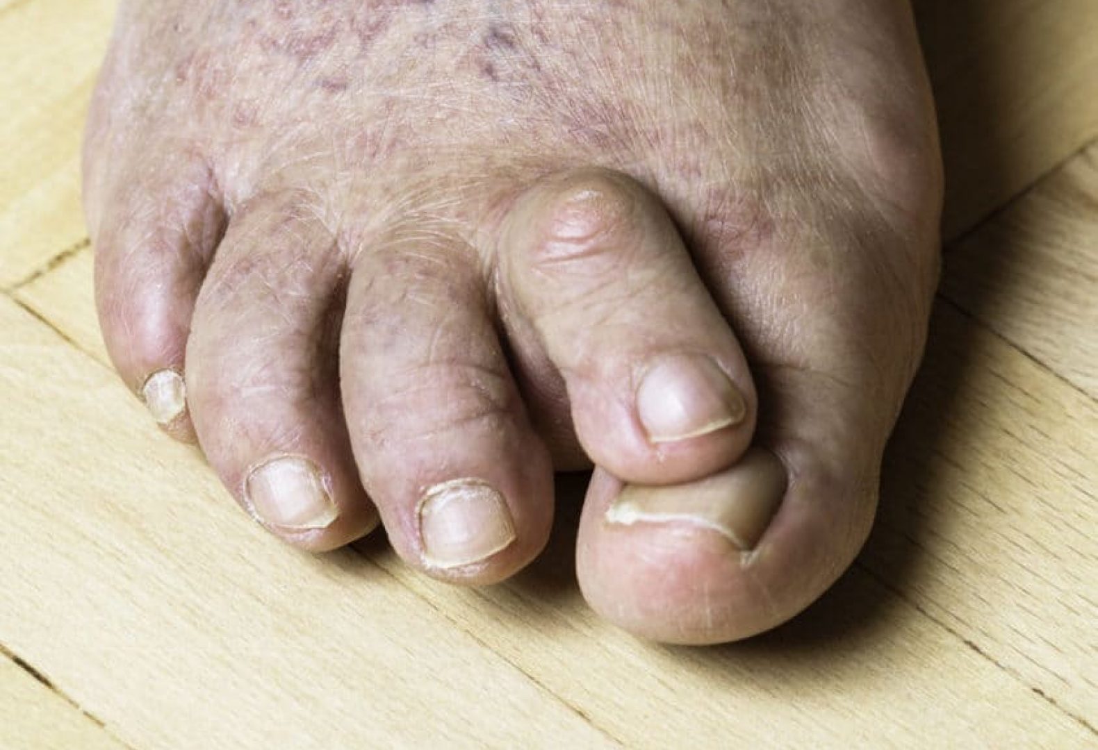 Hammertoe_iStock-1308950540-1920x1280 - crop
