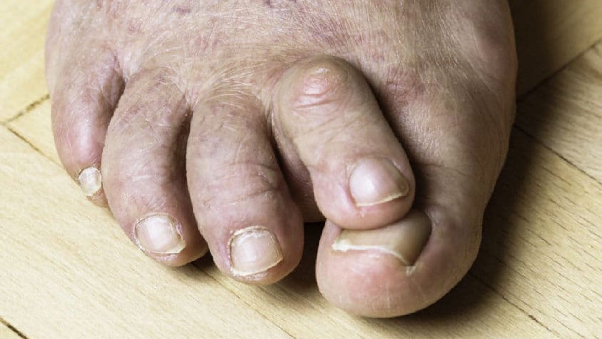 Hammertoe_iStock-1308950540-1920x1280 - crop
