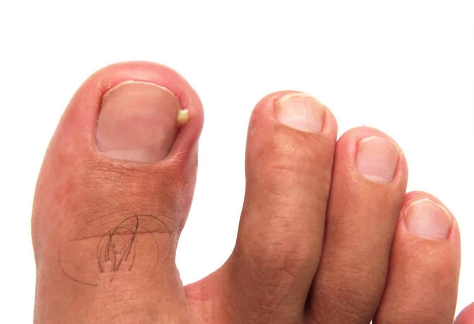 ingrown toenail with swelling and inflammation