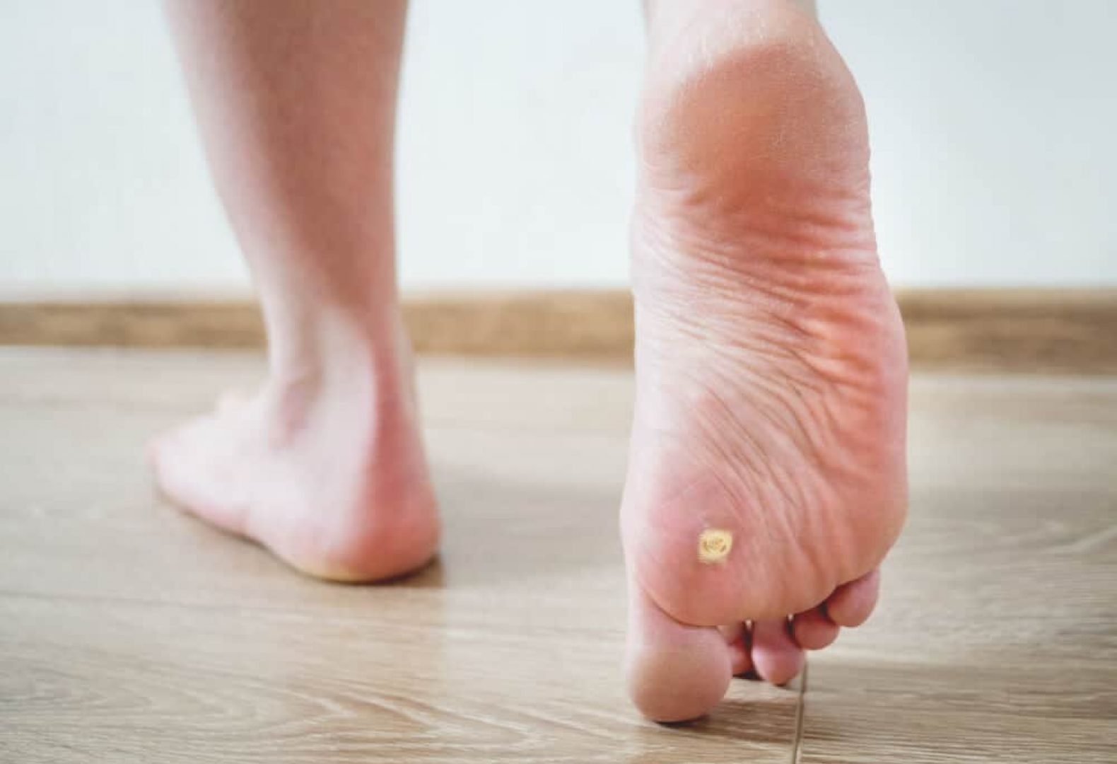 person walking on wooden floor one foot revealing a plantar wart at the bottom