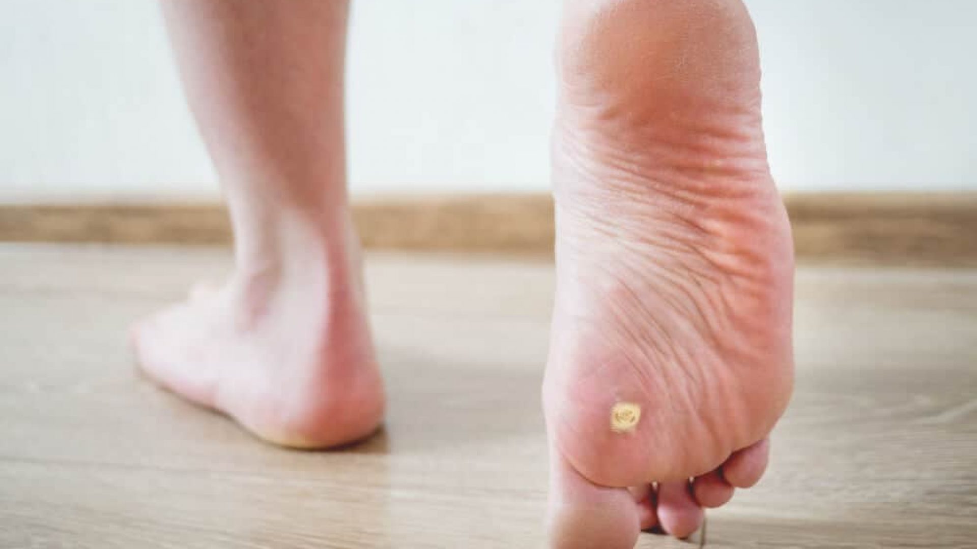 person walking on wooden floor one foot revealing a plantar wart at the bottom