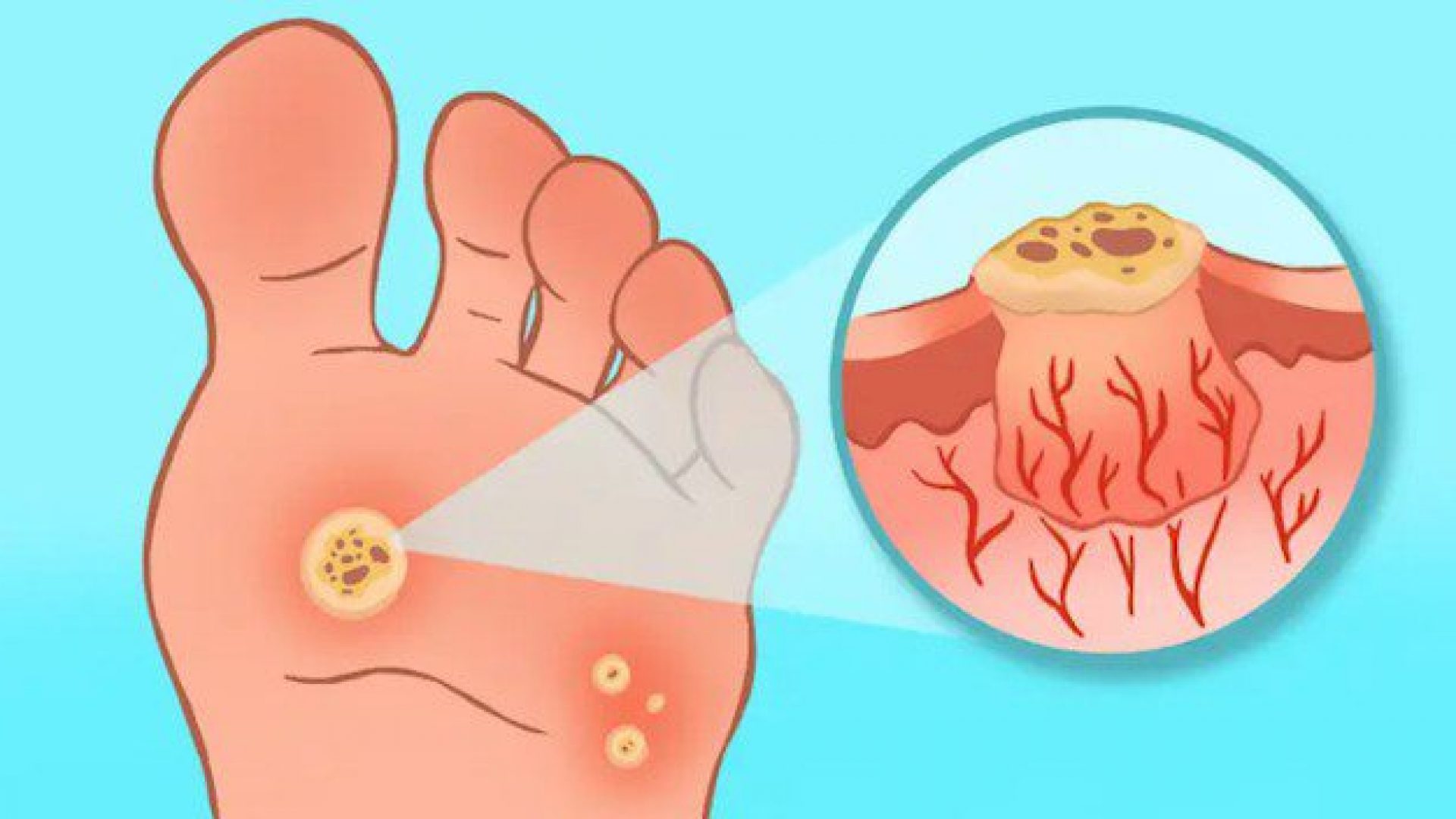 Image showing how plantar warts grow
