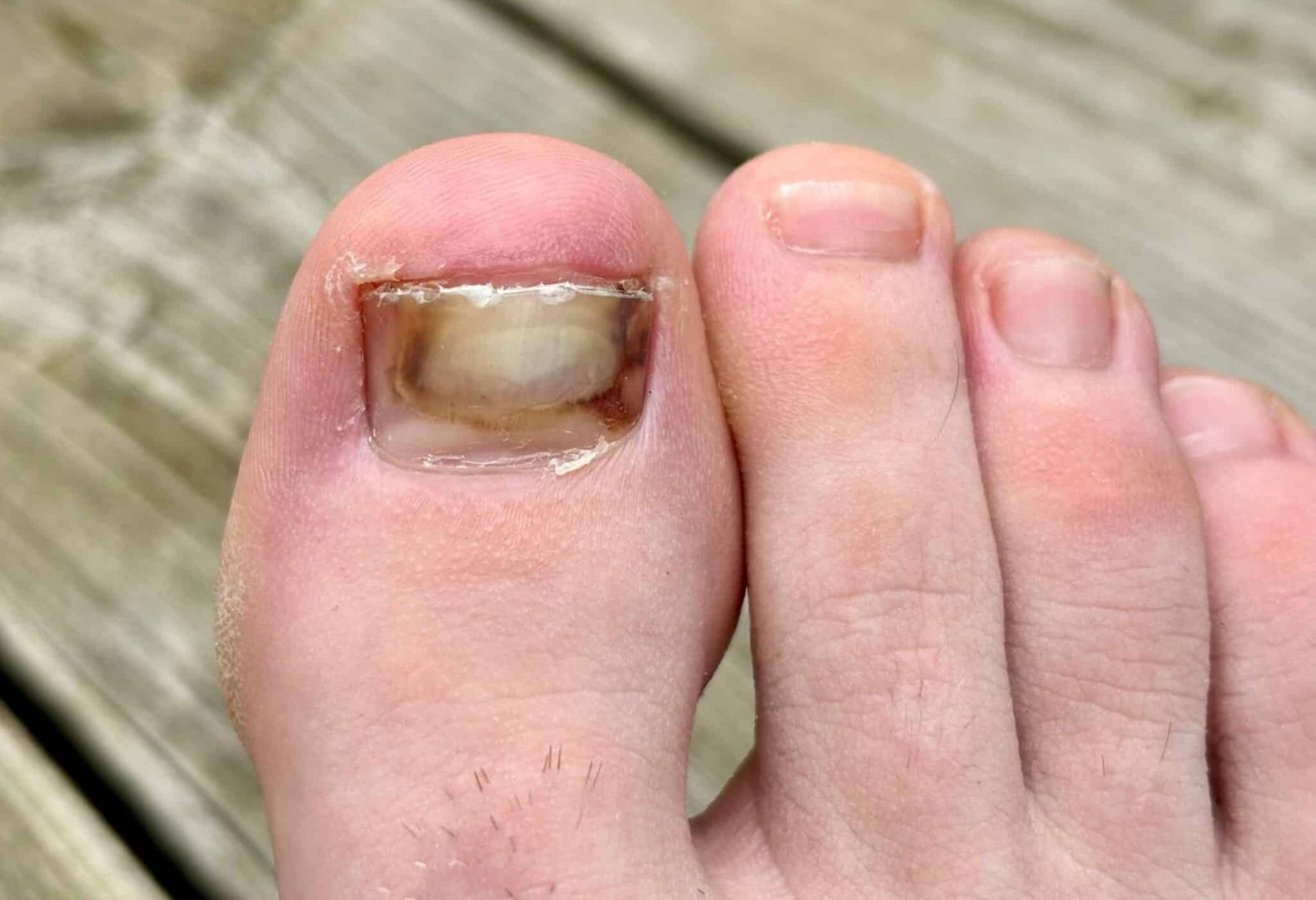 Tips For When Your Toenail Is on The Verge Of Falling Off