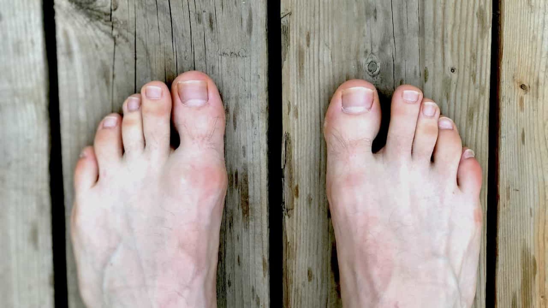 Toe Conditions