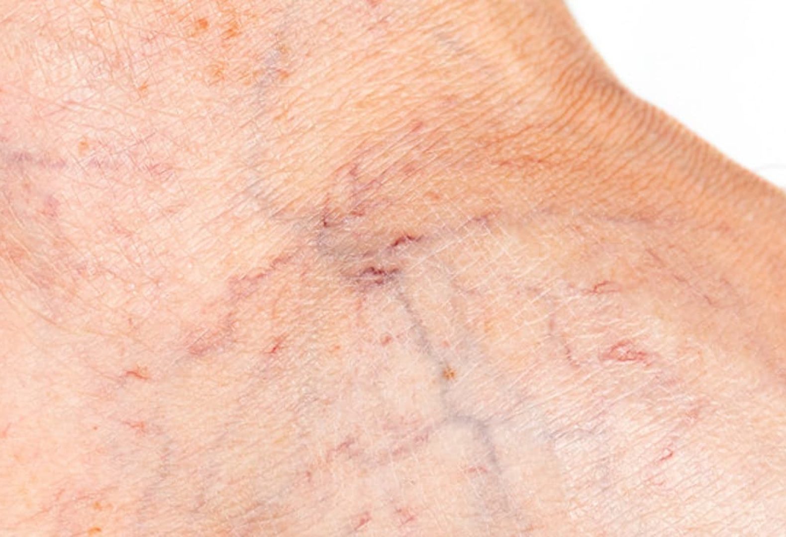 Varicose Veins