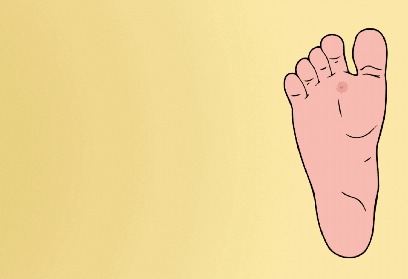 Illustration of feet with corns on the ball of foot and around the toes