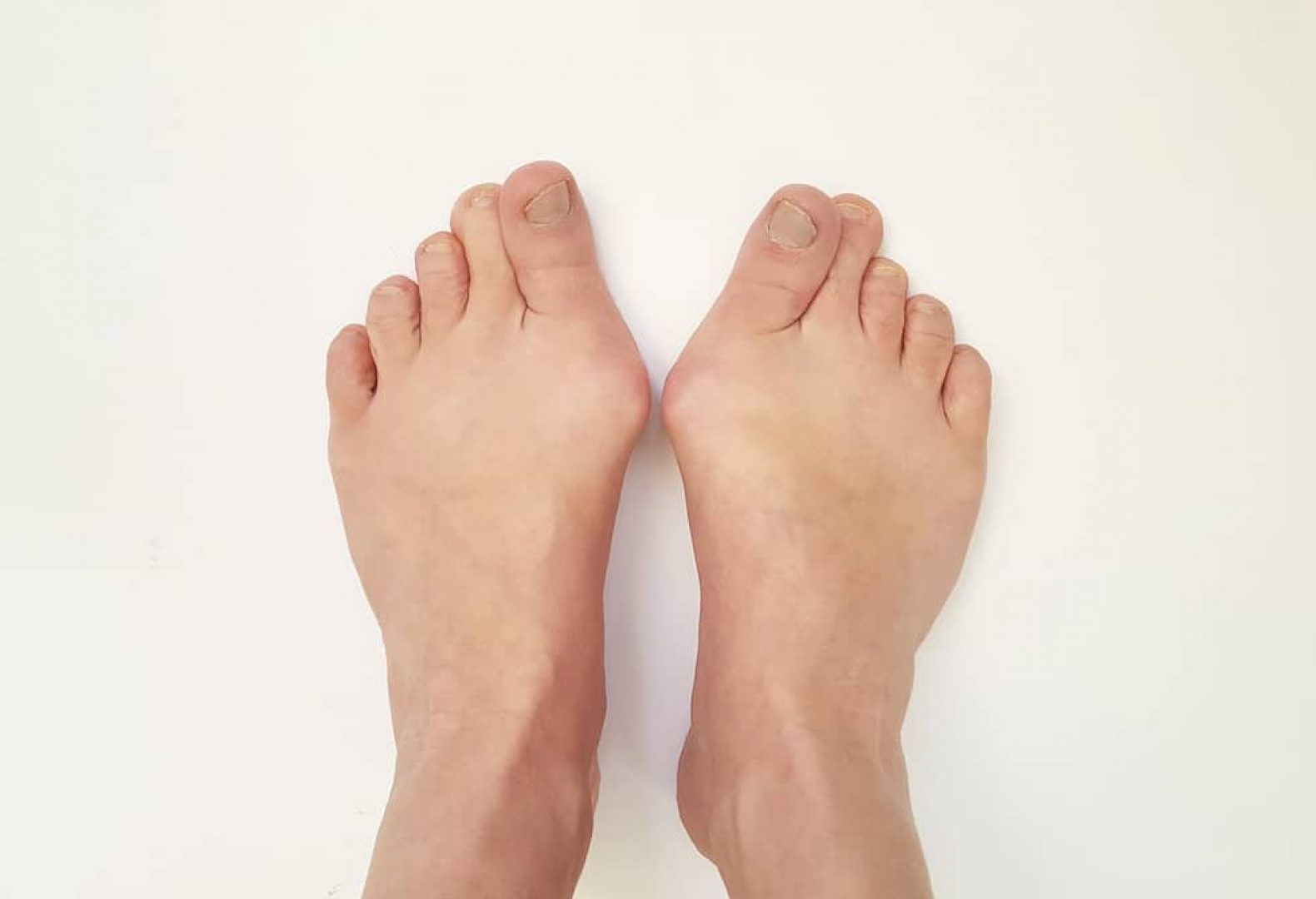 Two feet with bunions protruding from each side of the foot next to big toe and white background