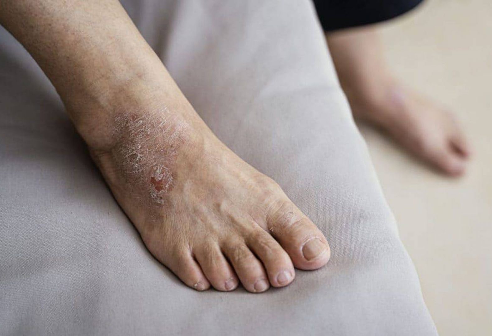 eczema toenail pitting
