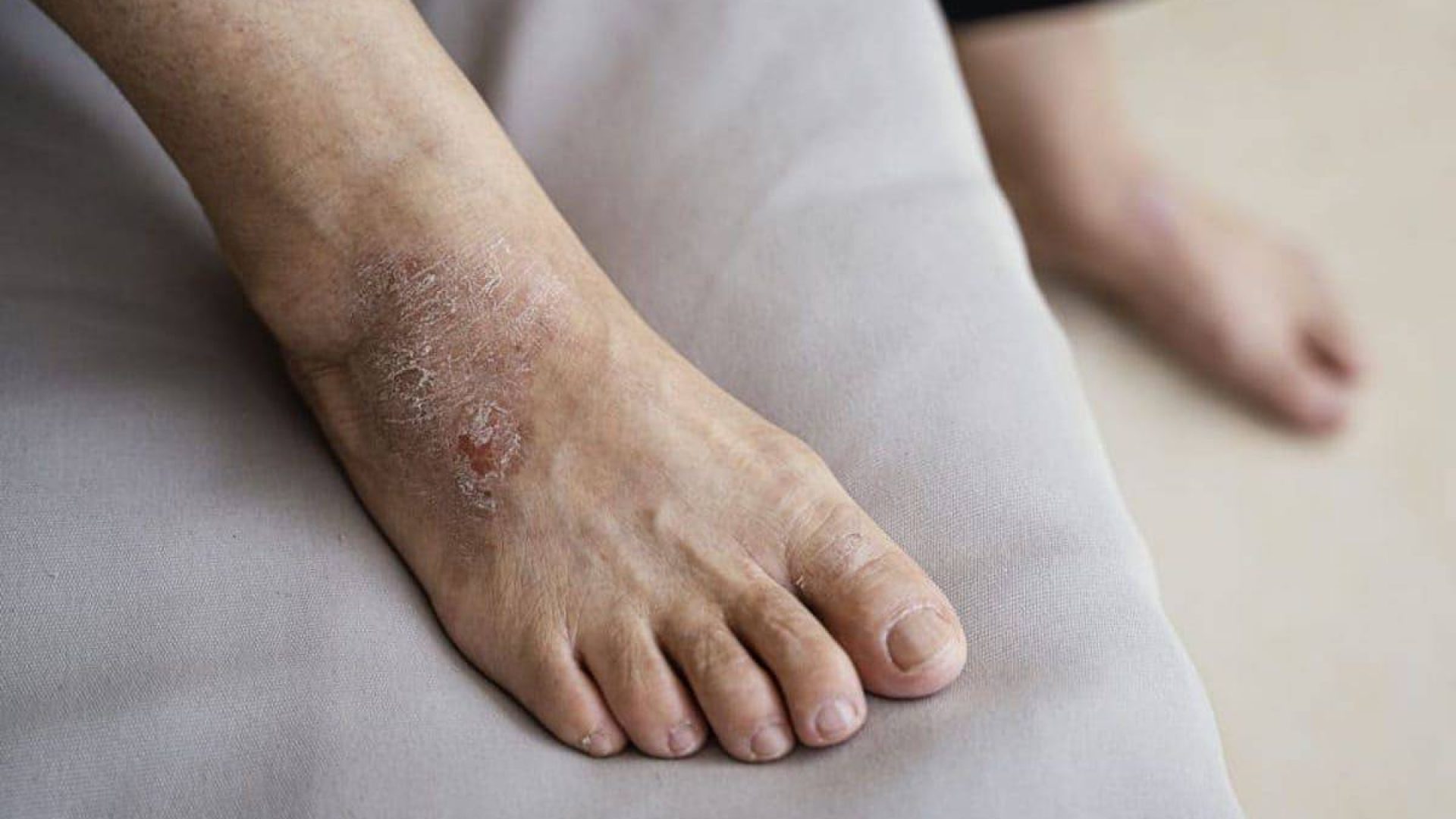 eczema toenail pitting