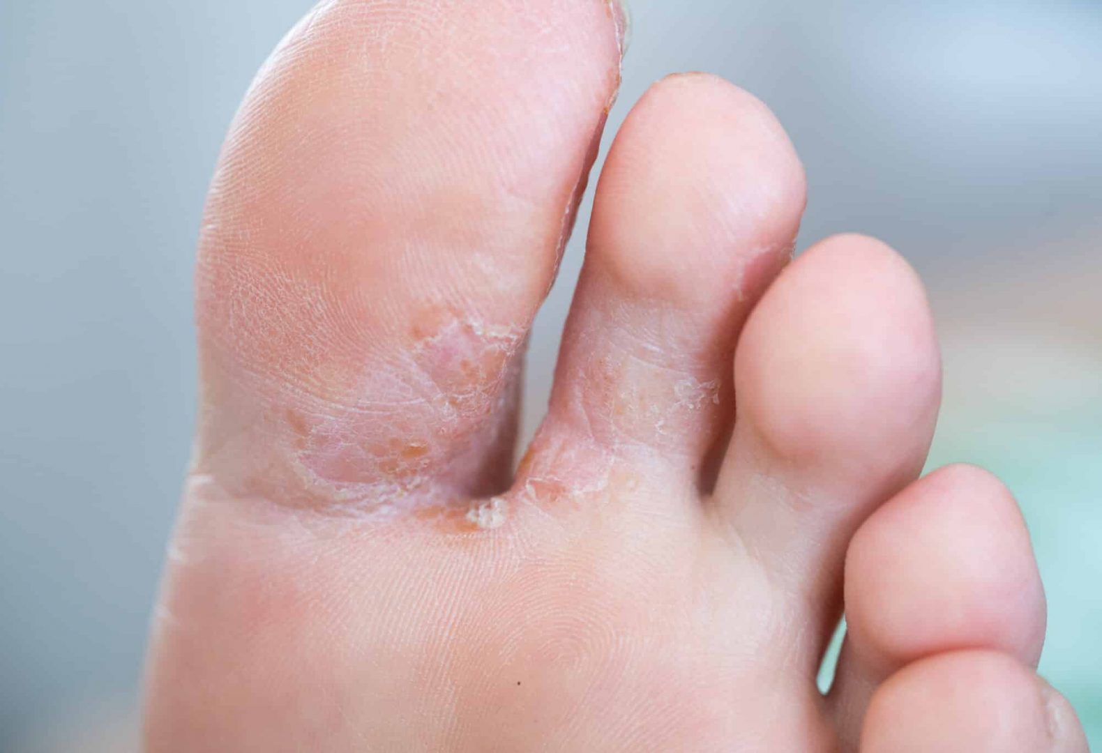 Close up of tinea pedis aka athlete's foot