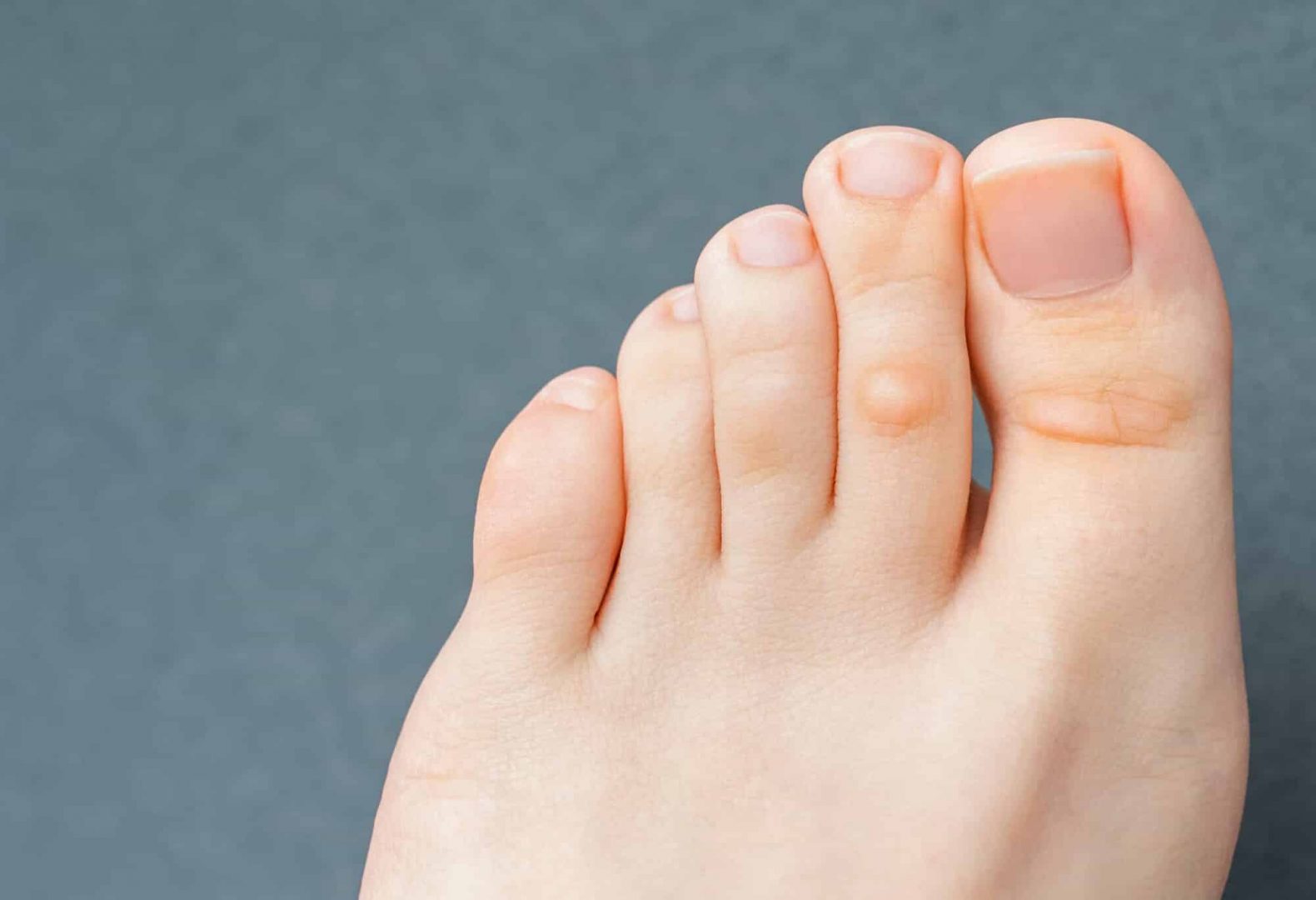 A young woman has hard corns and calluses on her toes from wearing shoes that uncomfortable and don"u2019t fit properly. Female foot. Close up view.