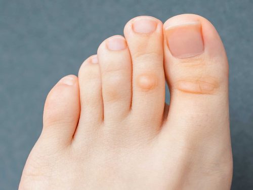 A young woman has hard corns and calluses on her toes from wearing shoes that uncomfortable and don"u2019t fit properly. Female foot. Close up view.